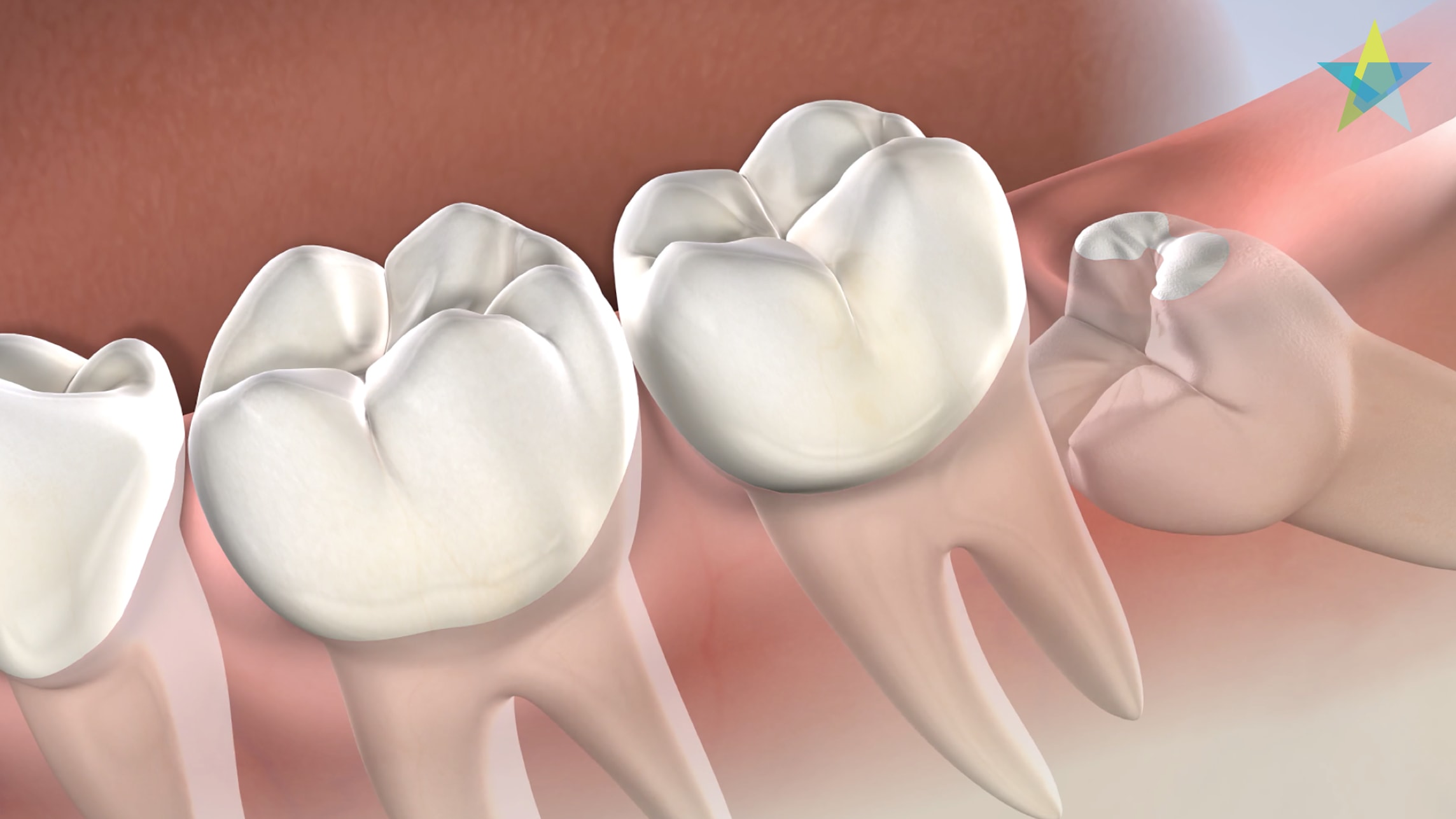 Procedure wisdom teeth removal