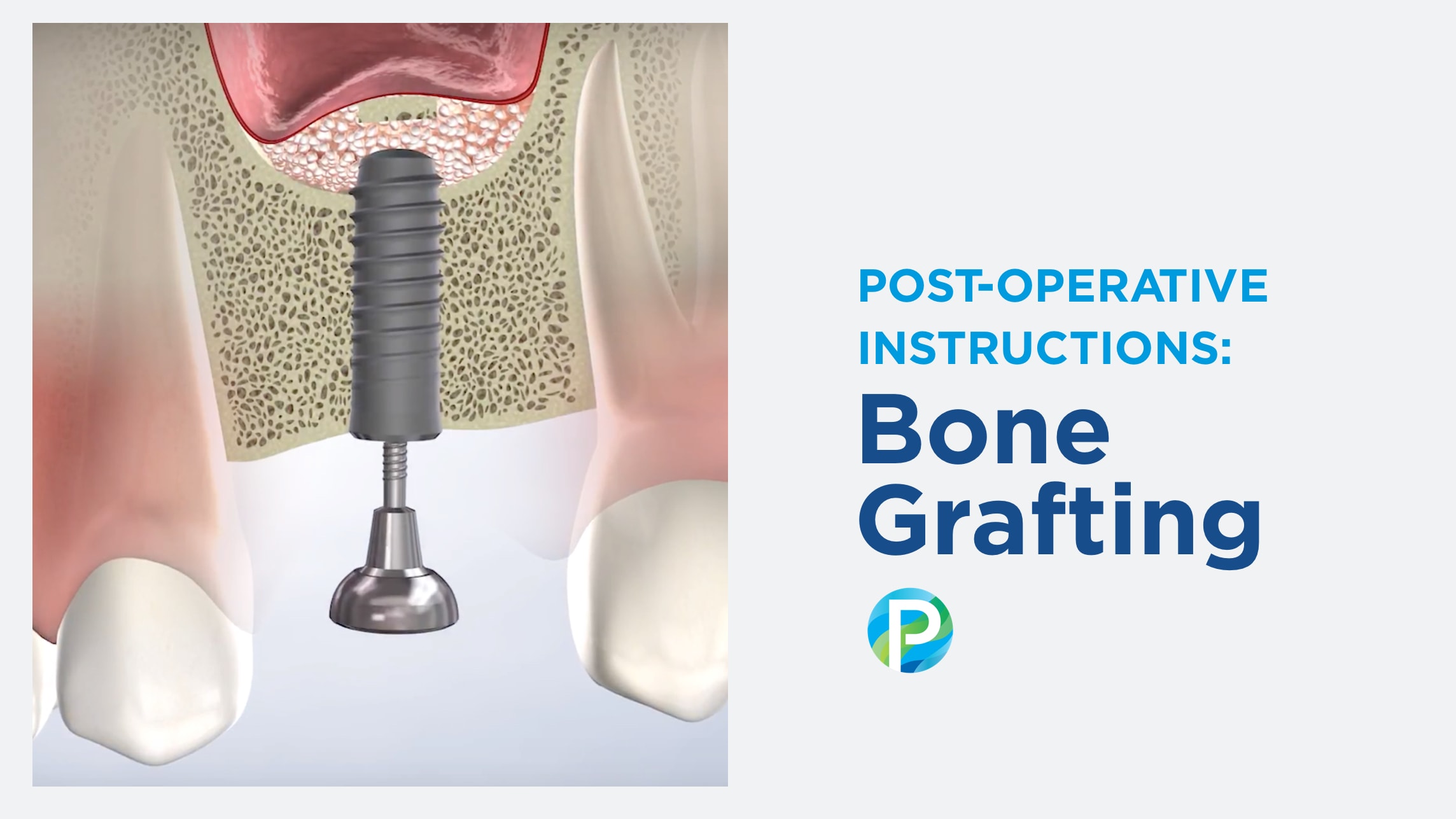 Instructions bone grafting