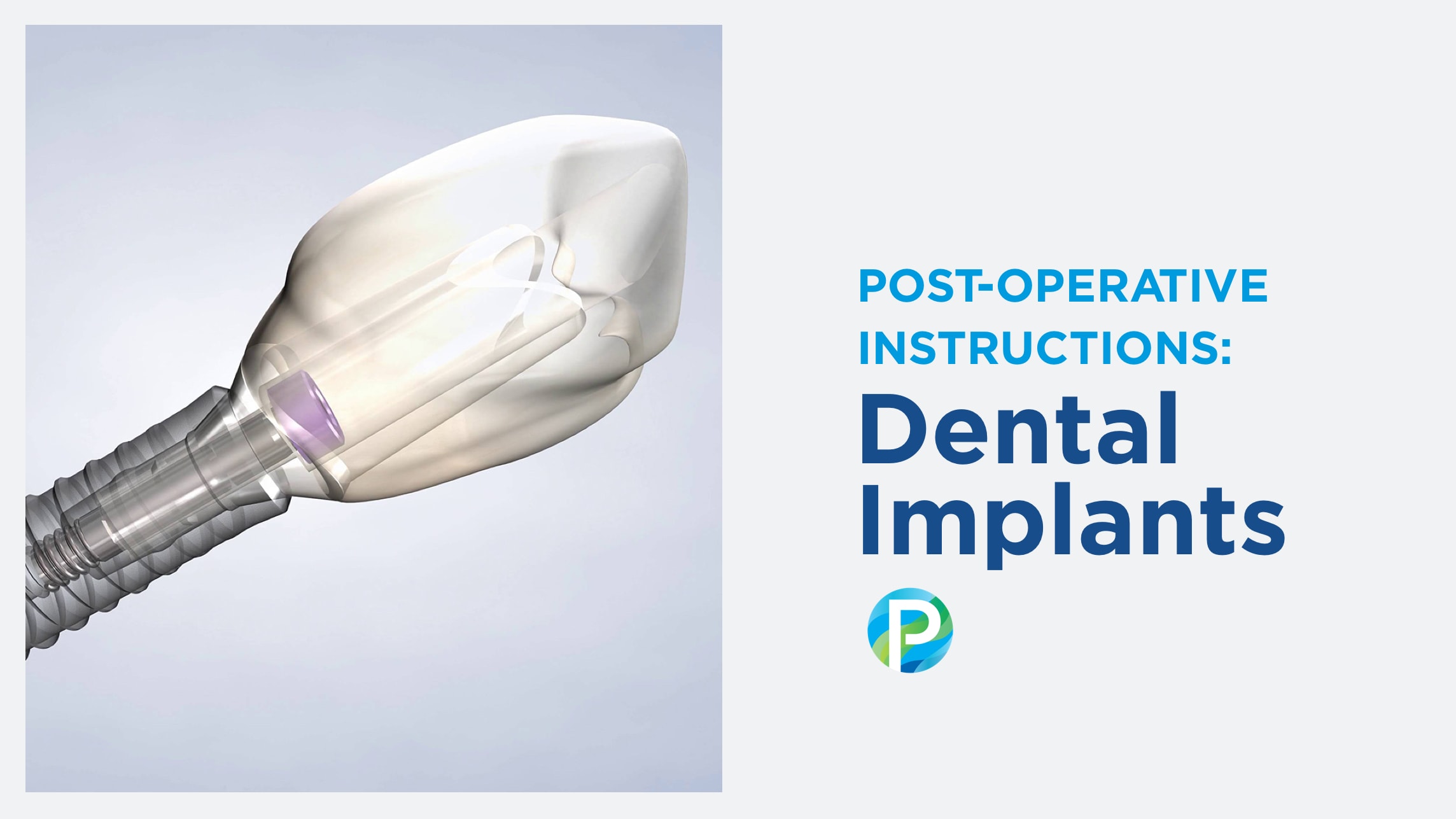 Instructions dental implants