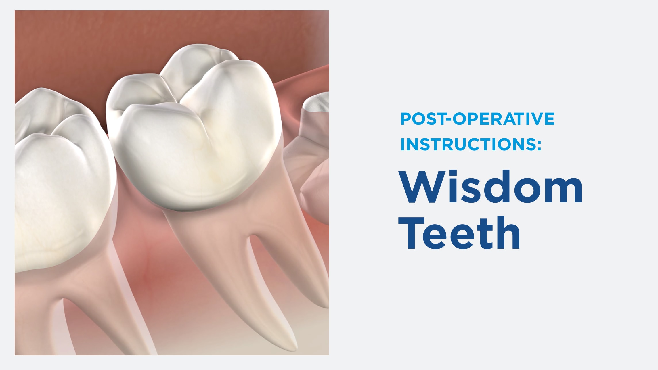 Instructions wisdom teeth