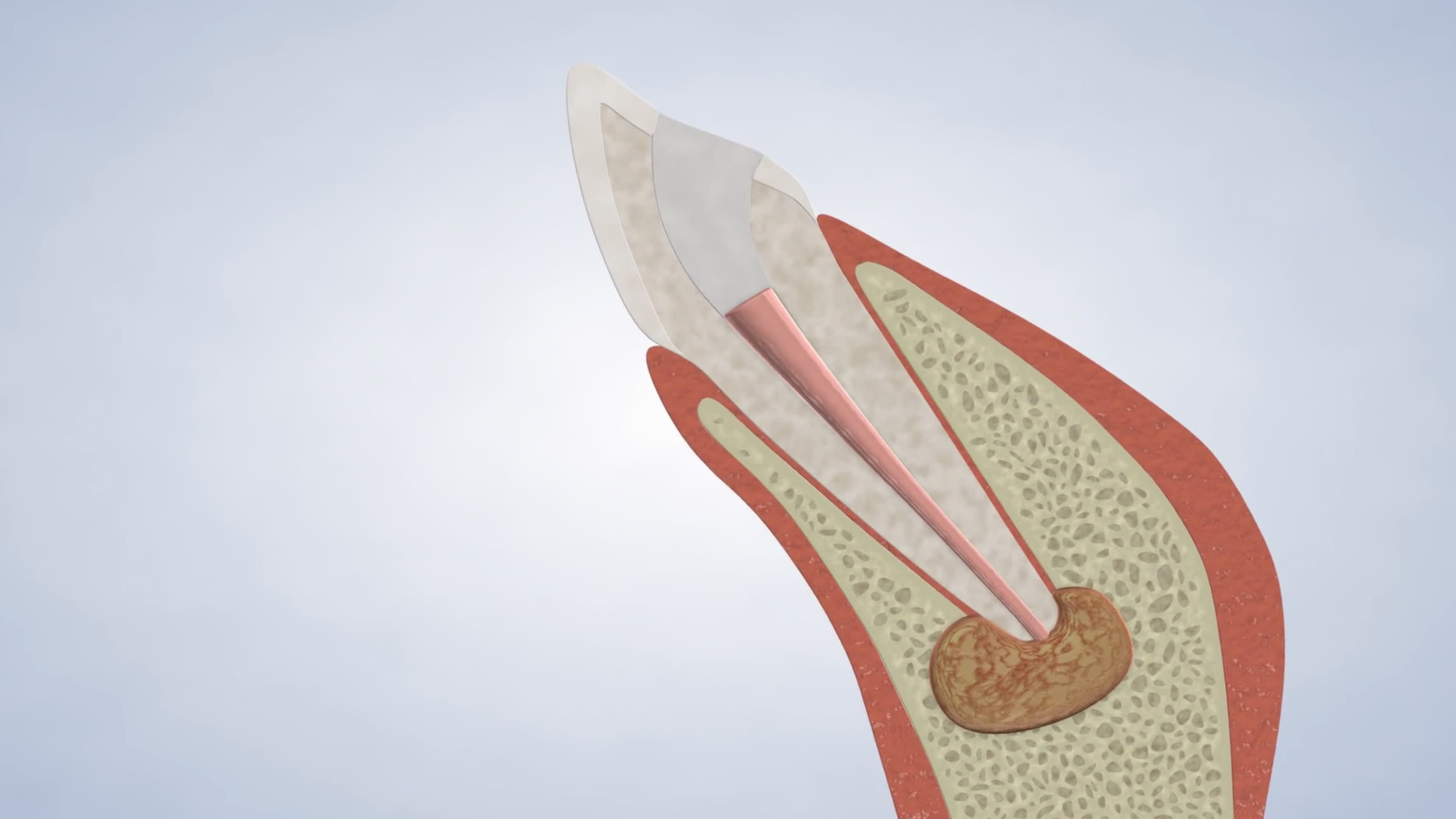 Instruction  apicoectomy