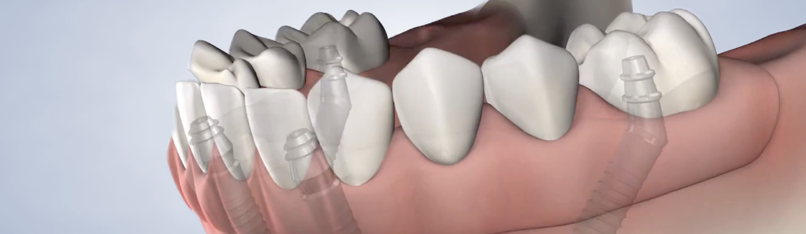 Full arch procedure lifestyle