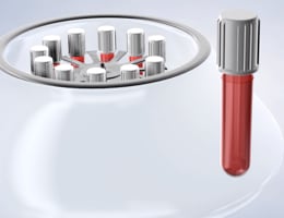 Platelet rich plasma procedure thumb