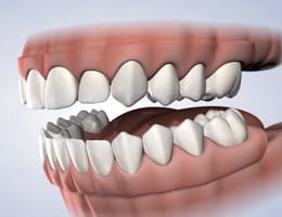 Pre prosthetic surgery procedure thumb