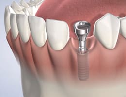 Tooth replacement options procedure thumb
