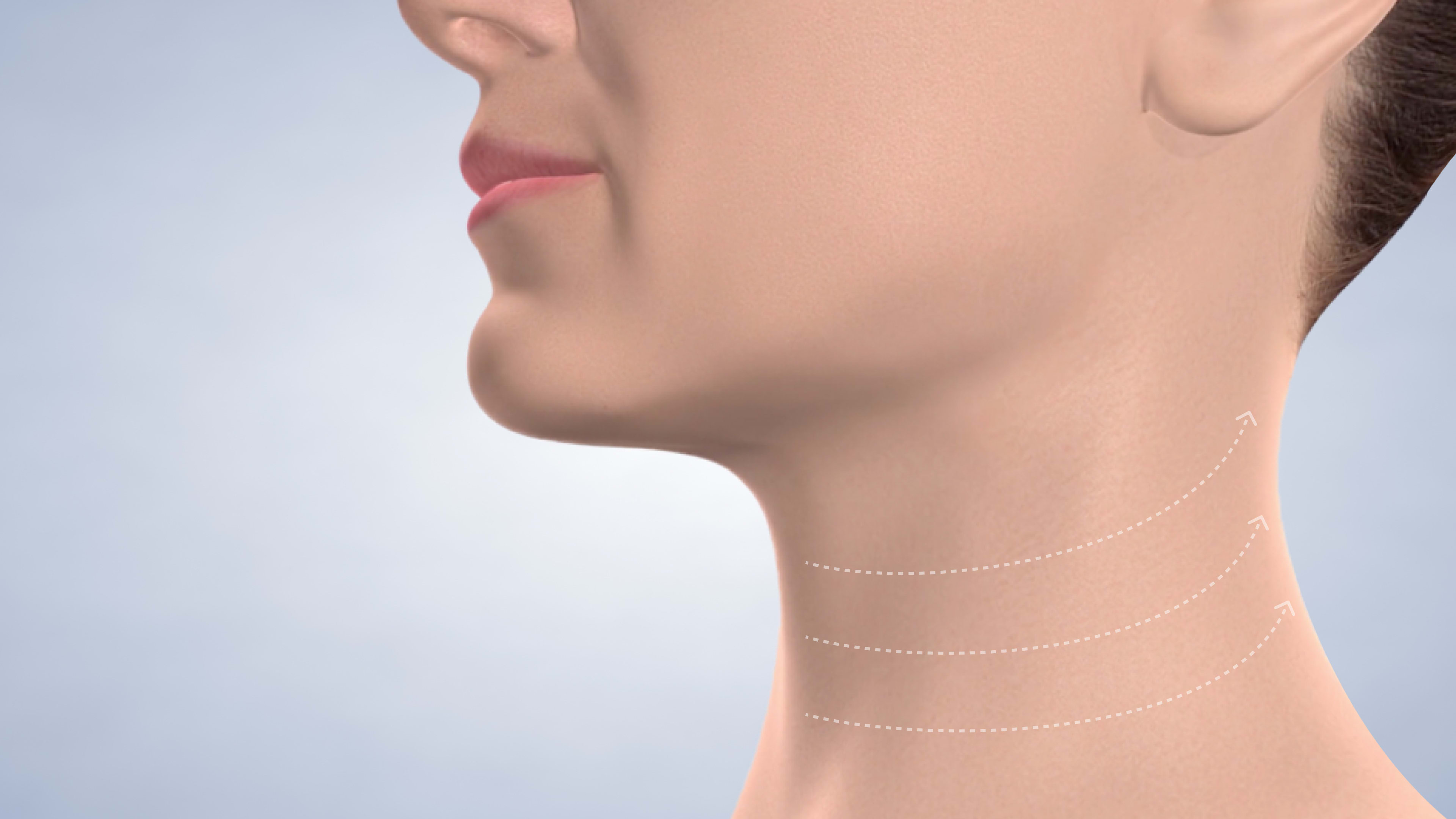 Instruction video thumb necklift