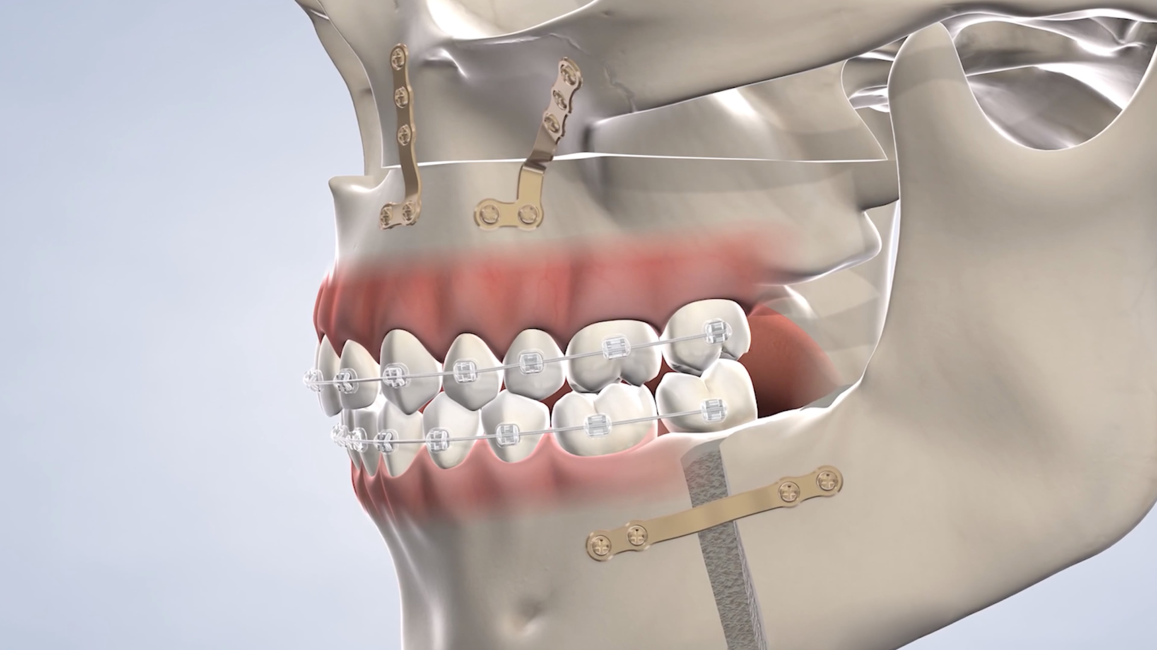 instruction  orthognathic