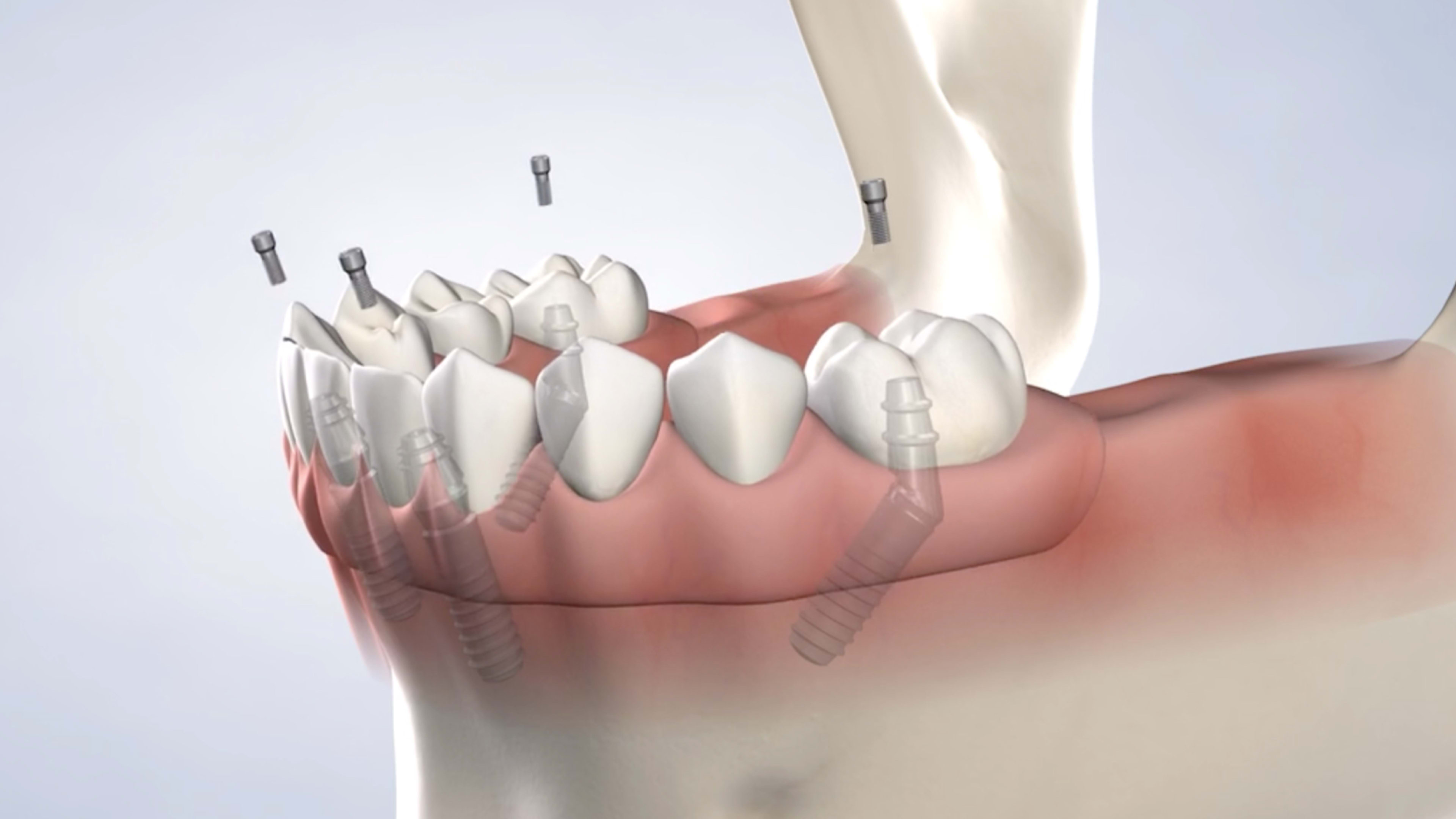 instruction  full arch restoration