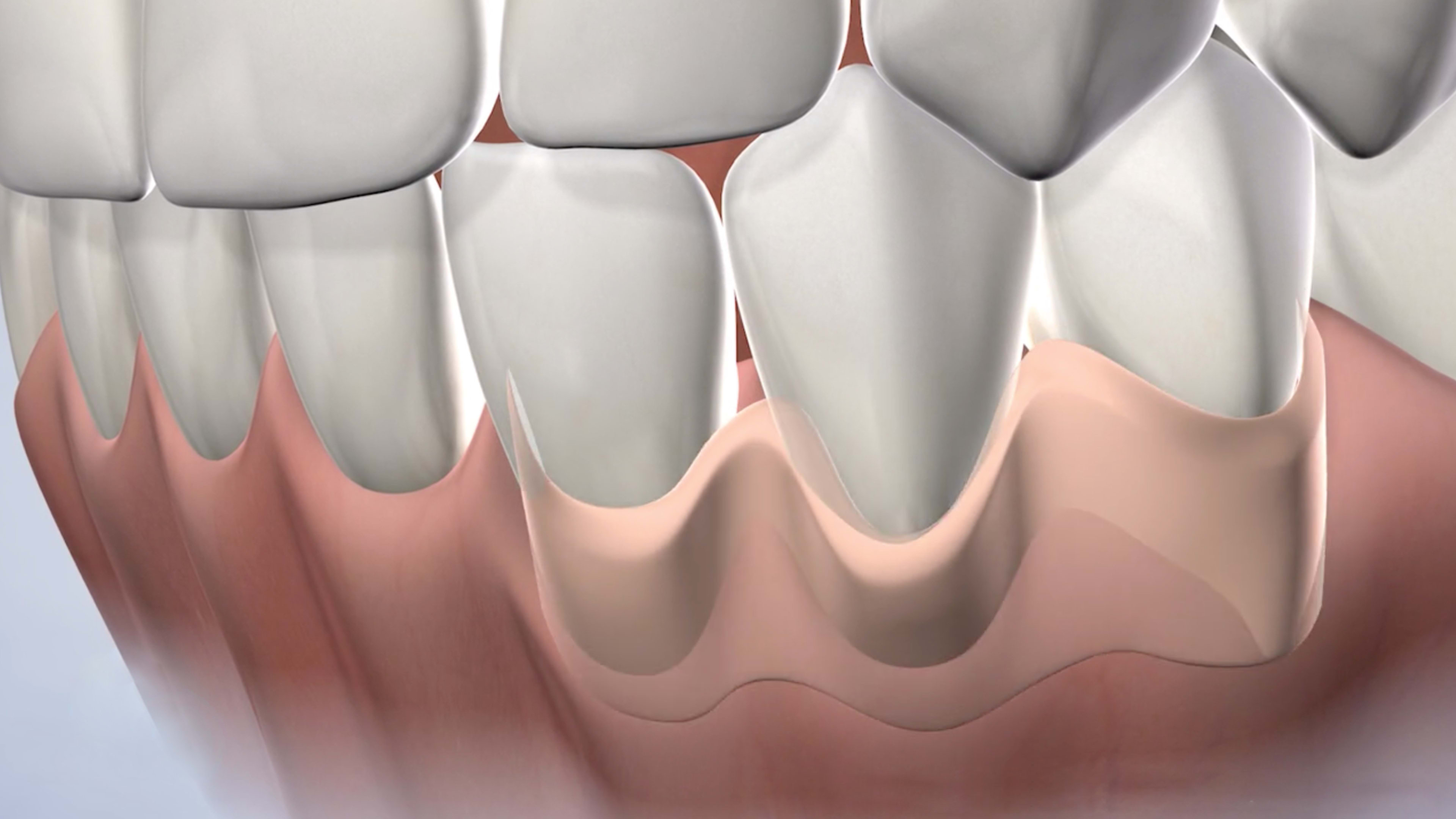 Instruction  soft tissue grafting