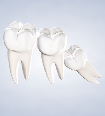 query  wisdom teeth removal
