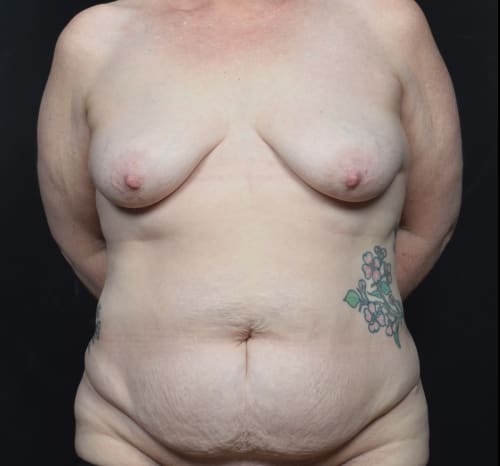 Query before patient 113