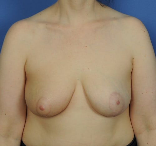 Query after patient 92