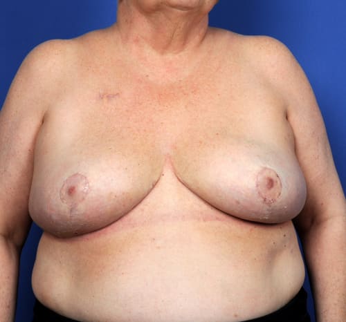 Query after patient 93