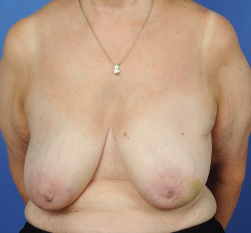 Query before patient 94