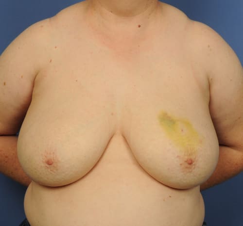 Query before patient 99