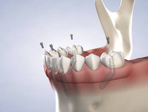Procedure allon4