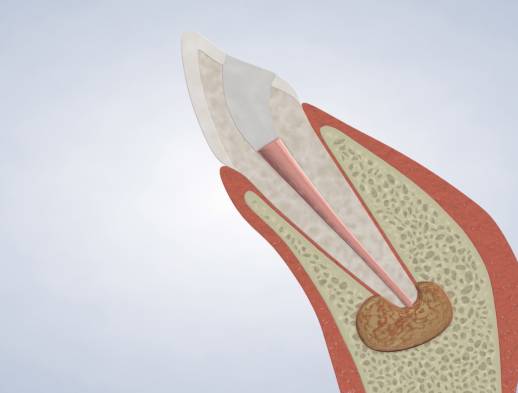 Procedure apicoectomy