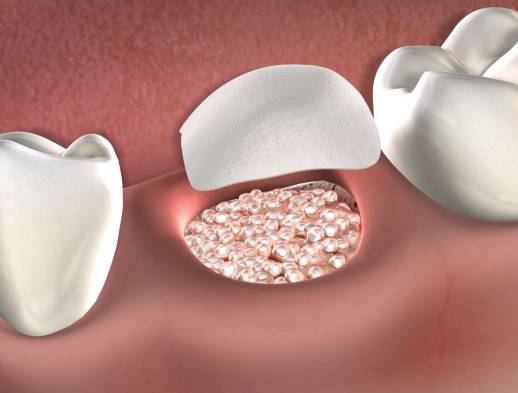 Procedure bone graft