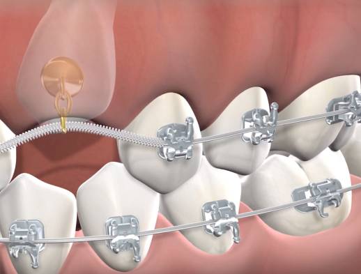Procedure impacted tooth exposure