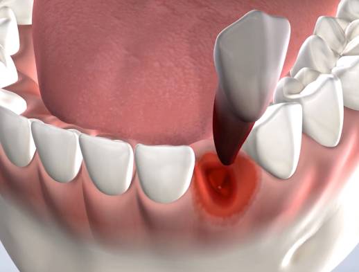 Procedure tooth extraction