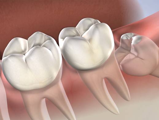 Procedure wisdom teeth