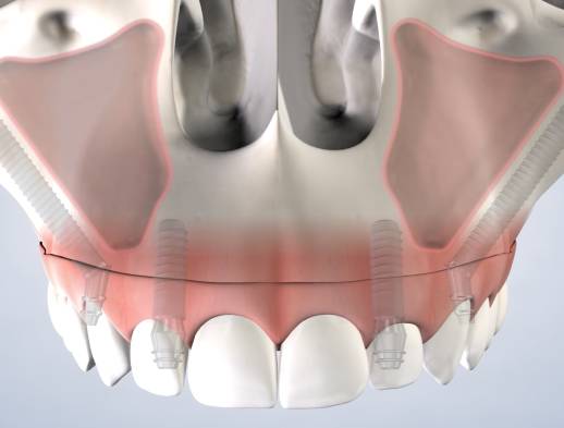 Procedure zygomatic implants