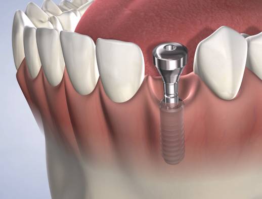 Query procedure dental implant
