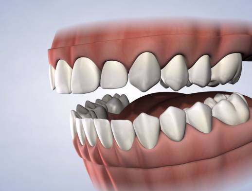 Query procedure dentures pre prosthetic