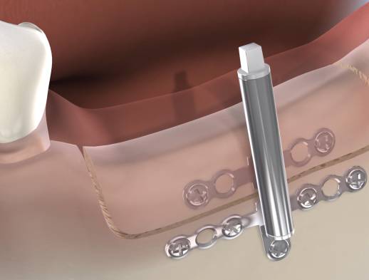 Query procedure distraction osteogenesis