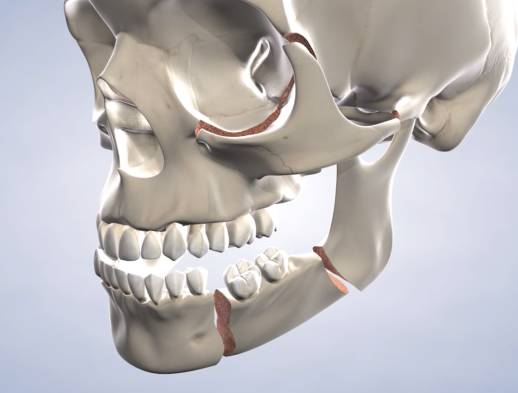 Query procedure facial trauma