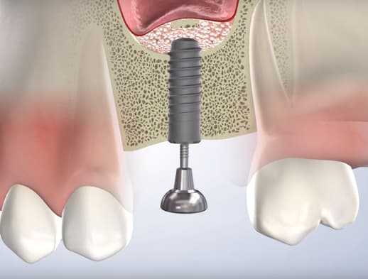 Bone grafting procedure thumb