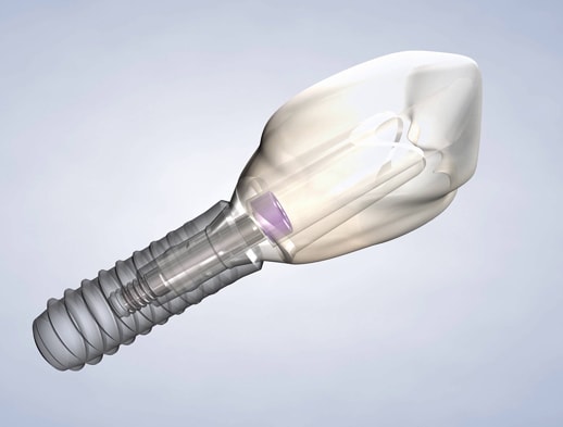 Dental implants procedure thumb