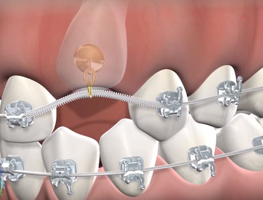 Impacted tooth exposure procedure thumb