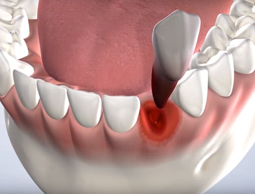 Tooth extractions procedure thumb