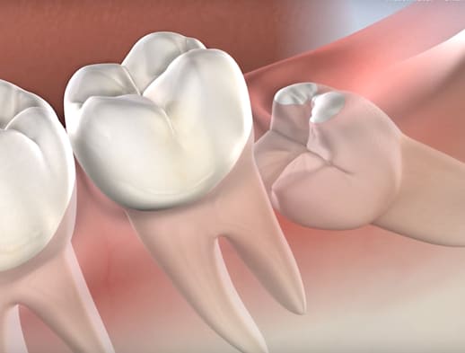 Wisdom teeth procedure thumb