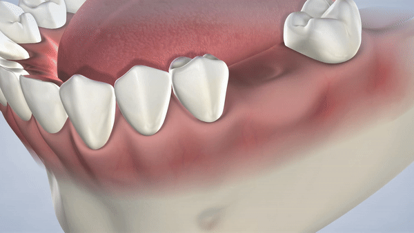 Dental implant gif