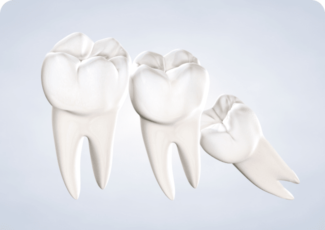 Home  wisdom teeth removal