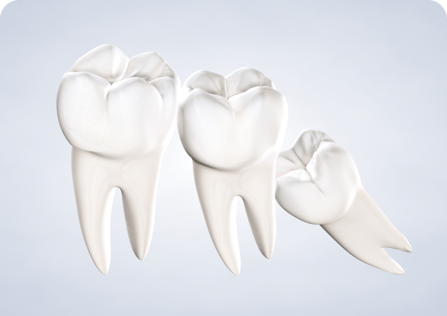 Home Wisdom Teeth Removal