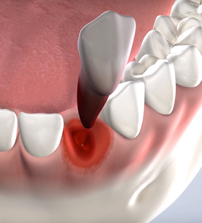 query  tooth extraction