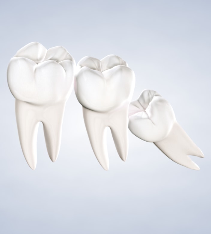 query  wisdom teeth removal