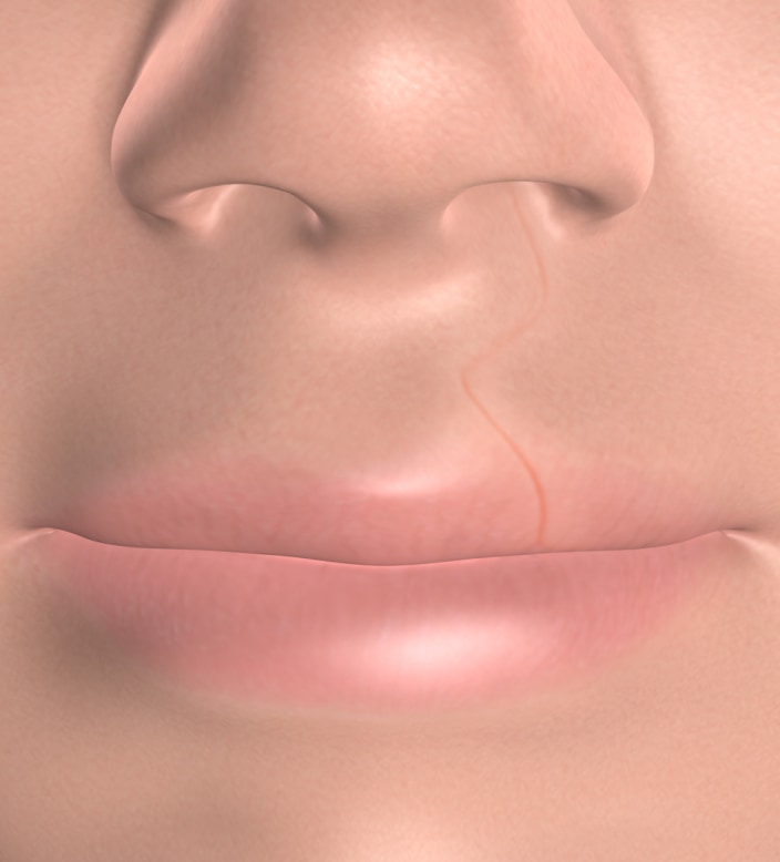 query  cleft lip and cleft palate