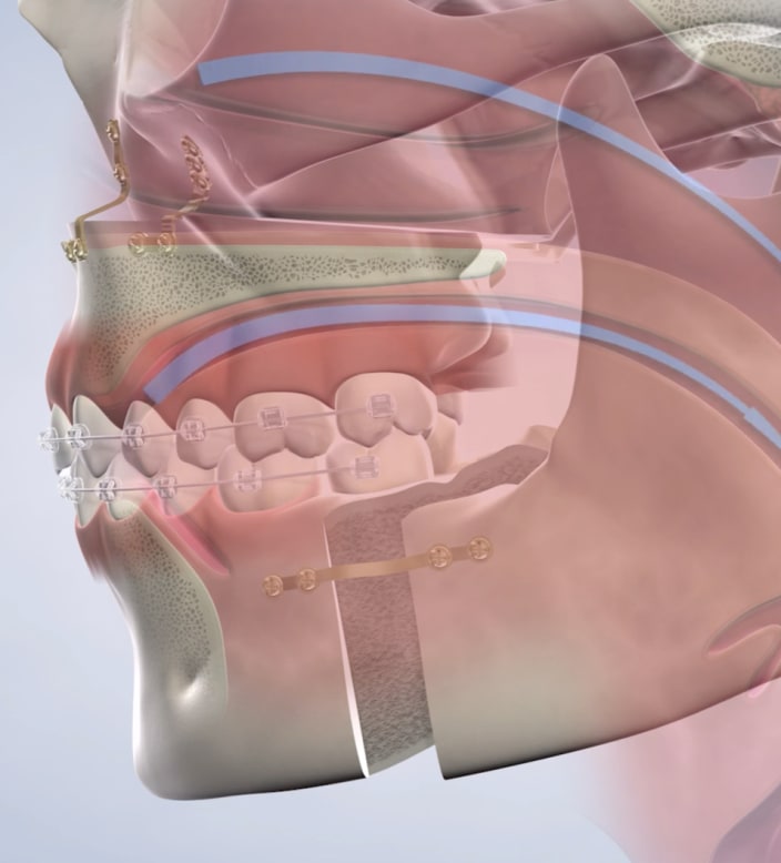 query  sleep apnea