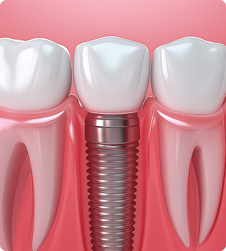 Blog detal implant marketing mobile