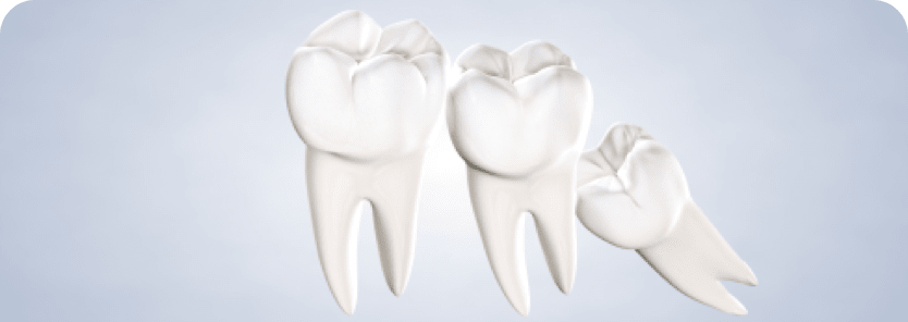 Wisdom teeth query image