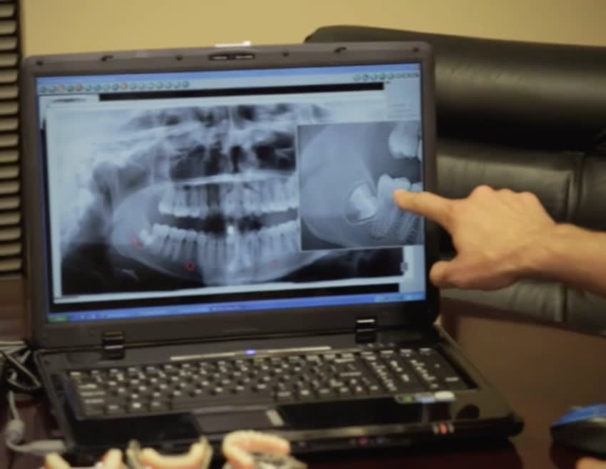 Impacted wisdom teeth x-ray