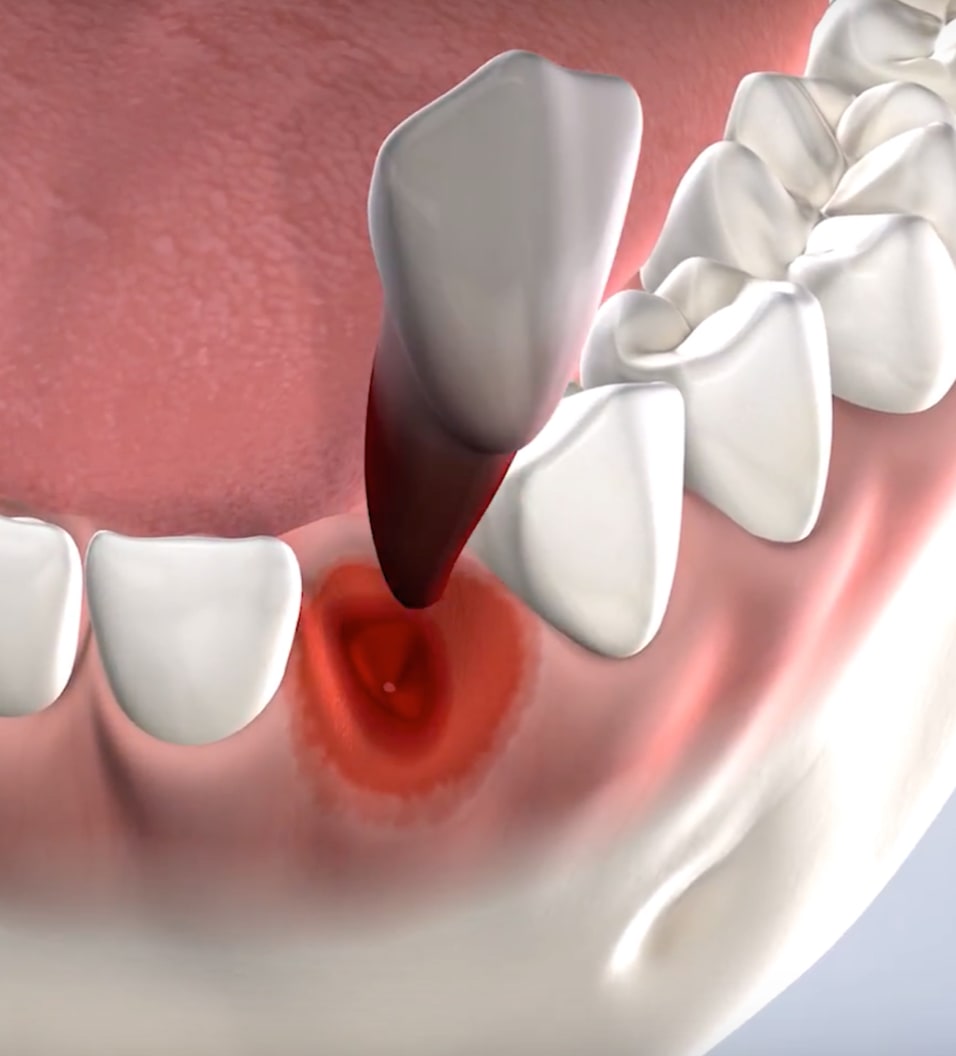 Query tooth extraction