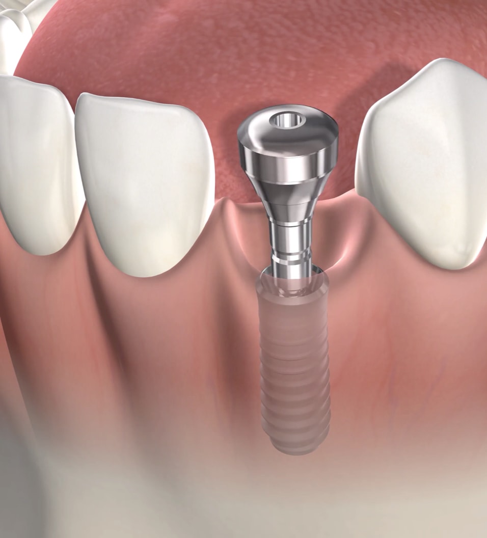 Query tooth replacement options