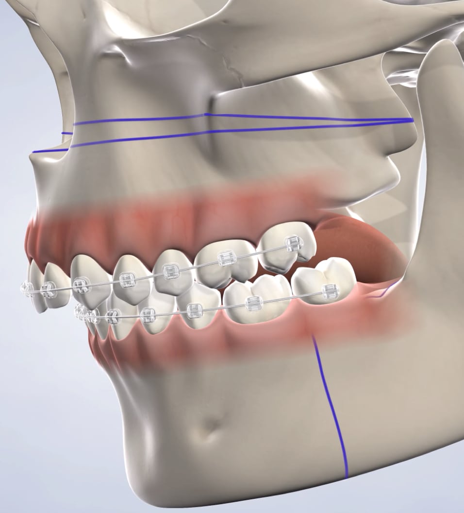query  orthognathic jaw surgery