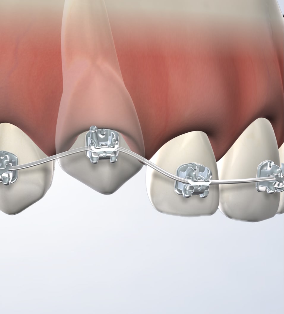 Tooth exposure in Fresno, Clovis, Reedley, and Madera, CA