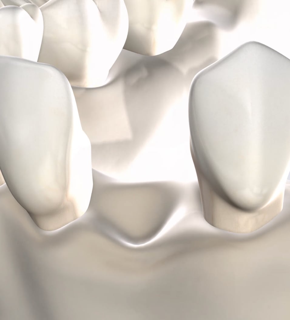 query  teeth extraction